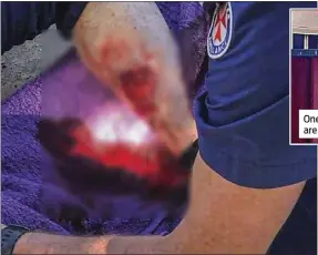  ??  ?? This photo shows the severity of the dog bite injury to the leg of the elderly female victim as she’s being treated at the scene of the attack by paramedics. Dubbo Photo News has pixelated the photo due to its graphic nature.