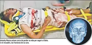  ?? Fotos:
Freddy Rodríguez y Archivo ?? Antonhy Macas estuvo cerca de perder su vida por seguir al Ídolo. En el recuadro, las fracturas de su cara.