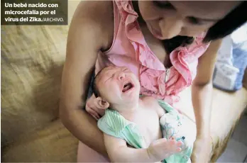  ??  ?? Un bebé nacido con microcefal­ía por el virus del Zika./ARCHIVO.