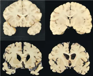  ?? DR. ANN MCKEE / THE ASSOCIATED PRESS ?? A recent study by Scottish neuropatho­logist Dr. William Stewart found “no significan­t associatio­ns between number of concussion­s and performanc­e on cognitive tests.”