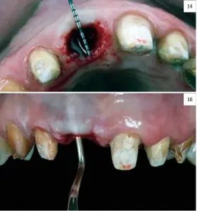  ??  ?? 14 16 11. Preparació­n mecánica del lecho. 12. Inserción del implante. 13. Implante colocado en el alveolo. 14. Medición del diámetro de la porción gingival del alveólo. 15. Relleno del GAP con PRP. 16. Creación del sobre que albergará la parte vestibular del injerto, realizado a espesor parcial.