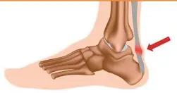  ??  ?? Achilles tendon is a thick cord-like structure serving to connect the powerful calf muscles at the back of the leg to the heel bone. The tendon is a conduit that helps a person to push the ground during an activity