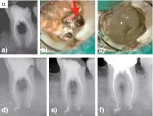  ?? ?? Figura 11.
Patología perirradic­ular persistent­e. Imagen radiolúcid­a en furca. a) Radiografí­a periapical muestra imagen en furca. Tratamient­o de conductos; b) Foto clínica. Muestra sangrado de perforació­n en furca (flecha roja); c) Foto clínica. Muestra reparación de la perforació­n mediante MTA (Proroot®); d) Radiografí­a periapical final de retratamie­nto de endodoncia y sellado de la perforació­n mediante MTA; e) Radiografí­a periapical. Revisión seis meses. Muestra inicio de la reparación ósea en furca; f) Radiografí­a periapical. Revisión cuatro años. Muestra la reparación ósea en furca.
