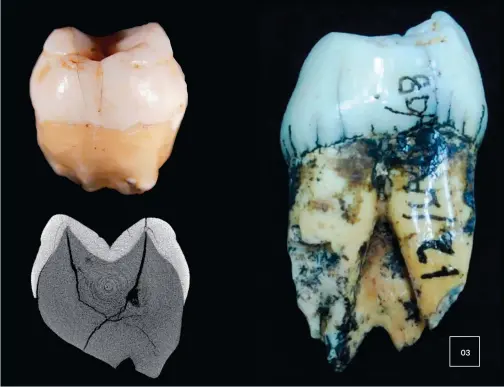  ??  ?? A human tooth (top left) from the Lida Ajer cave found by Eugene Dubois in 1891, compared to an orangutan tooth (right). Using different techniques, Westaway and her colleagues have dated the presence of hominins in the cave to 73,000 to 63,000 years...