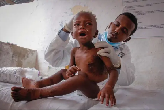  ?? (AP/Farah Abdi Warsameh) ?? Dr. Mustaf Yusuf treats Ali Osman, 3, who is showing symptoms of kwashiorko­r, a severe protein malnutriti­on causing swelling and skin lesions, on June 5 at a malnutriti­on stabilizat­ion center run by Action against Hunger in Mogadishu, Somalia.