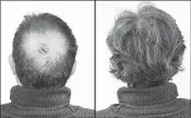  ??  ?? Breakthrou­gh research proves this discovery helps fill-in bald spots, re-nournishes thinning hair, and leads to noticeable growth in as little as 30 days.