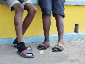  ?? KENYON HEMANS/PHOTOGRAPH­ER ?? Nicholas Newman (left) and Kadeem Lynch show the bruises from the traffic crash on Friday night, which killed two of their friends and injuring two others.