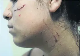  ?? JUANO TESONE ?? Heridas.
Una chica atacada por otra alumna en Quilmes.