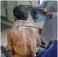  ?? — AP ?? A Kashmiri man with his pellet ridden back at a hospital in Srinagar.