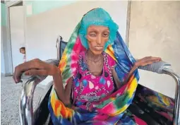  ?? FOTO: REUTERS/NTB SCANPIX ?? 18 år gamle Saida Ahmad Baghili er en av stadig flere ofre i borgerkrig­en i Jemen. Hun får nå behandling på al-Thawra-sykehuset i Houdieda.