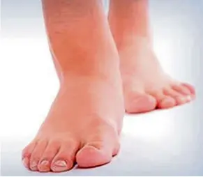  ??  ?? Swollen feet and legs due to congestion are a common sign of heart failure. — Filepic