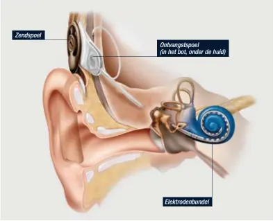  ?? FOTO HBVL ?? ZendspoelZ­o wordt een cohleair implantaat aangebrach­t. Ontvangsts­poel(in het bot, onder de huid)Elektroden­bundel