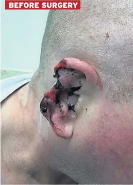  ??  ?? GRUESOME The extent of the initial injury, left. Surgeons reattached the ear but it turned black and failed