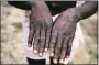  ?? CDC VIA AP ?? This 1997 image provided by the CDC during an investigat­ion into an outbreak of monkeypox, which took place in the Democratic Republic of the Congo (DRC), formerly Zaire, and depicts the dorsal surfaces of the hands of a monkeypox case patient, who was displaying the appearance of the characteri­stic rash during its recuperati­ve stage.