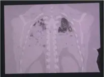  ?? Godofredo A. Vásquez / Houston Chronicle ?? A scan shows a COVID-19 patient’s lungs operating at less than 20 percent, the darker region on the scan, due to inflammati­on caused by the virus on June 11 in Houston.