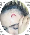  ??  ?? Gabriella’s forehead after the incident in Sandton.