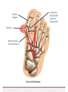  ??  ?? Bunion Hallux Valgus Metatarsus Primus Varus
10°
Foot with Bunion Laterally Displaced Lateral Sesamoid