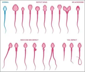  ?? — 123rf.com ?? In teratozoos­permia, abnormal-looking sperm (seen here in red) comprise 96% or more of the man’s sperm.