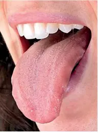  ??  ?? A scalloped tongue (one with ridges on the outside edge) indicates fluid retention (stock image)