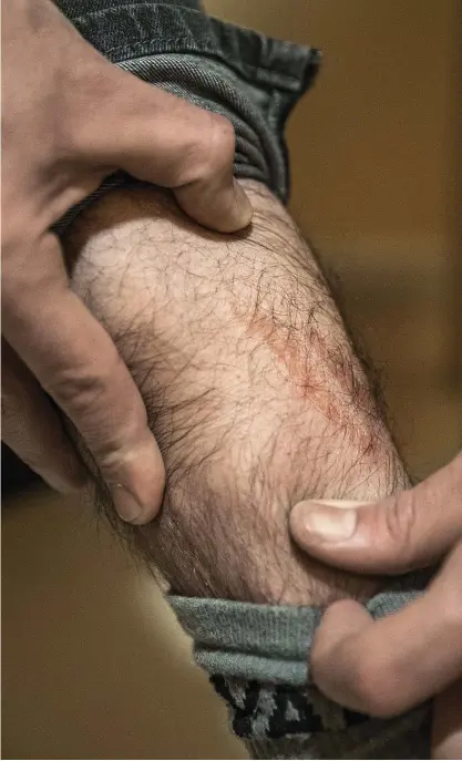  ?? FOTO: LEIF WECKSTRöM ?? Ali berättar att han blivit kidnappad i hemlandet och visar upp ärr på benet och magen efter det våld han utsatts för.