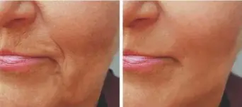  ??  ?? Revolution­ary new derma-filler cream takes 10 years off your face in just 10 minutes