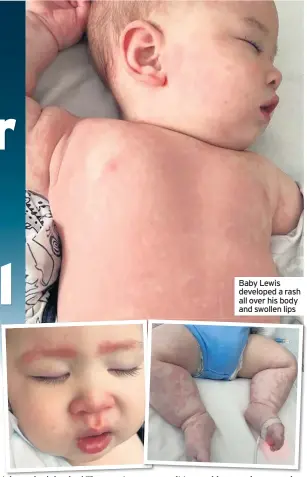  ??  ?? Baby Lewis developed a rash all over his body and swollen lips