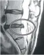  ??  ?? BEFORE Example images: In the before picture you can see the herniated disc (black) protruding into the spinal column (white, center of MRI). After decompress­ion treatment, the MRI shows the herniated disc is no longer bulging into the spinal canal...