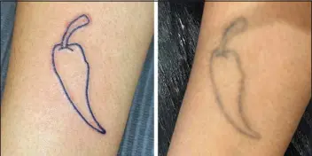  ?? EDEN BEKELE VIA THE NEW YORK TIMES ?? Photos provided by Eden Bekele show the temporary tattoo that she got when new, left, and 18 months later, right.