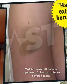  ??  ?? Modellen uppger att skadorna uppkommit när Ryan puttat henne nerför en trappa.