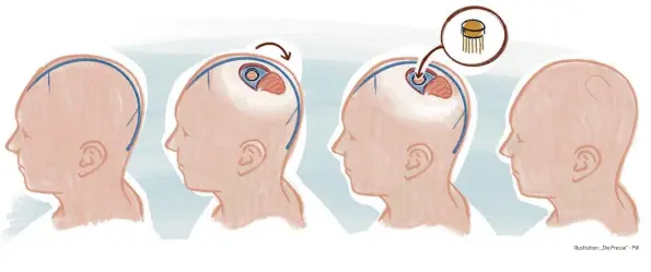  ?? Illustrati­on: „Die Presse“· PW ?? Eine münzgroße Sonde wird in das Gehirn eingebaut. An ihr hängen hauchdünne Fäden, die mit einem chirurgisc­hen Roboter verlegt werden. An ihnen sind Elektroden angebracht, die neuronale Signale auffangen können.