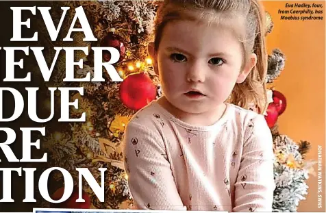  ?? ?? Eva Hadley, four, from Caerphilly, has Moebius syndrome