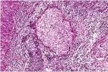  ??  ?? Micrograph­ie d’un carcinome du nasopharyn­x.