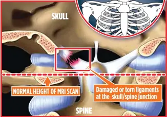  ??  ?? Damaged or torn ligaments at the skull/spine junction NORMAL HEIGHT OF MRI SCAN SPINE SKULL