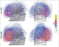  ?? COGNITIVE SCIENCE, LYON, FRANCE VIA AP CNRS MARC JEANNEROD INSTITUTE OF ?? Brain activity in a patient before, top row, and after vagus nerve stimulatio­n. Warmer colors indicate an increase of connectivi­ty. In a report published Monday, French doctors say they restored some signs of consciousn­ess in a brain-injured man who...