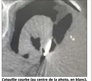  ??  ?? L’aiguille courbe (au centre de la photo, en blanc), brevetée par le docteur Philippe Brunner, a été insérée dans la tumeur du rein et congèle les cellules malignes pour les détruire totalement.