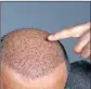  ?? REPRESENTA­TIONAL IMAGE ?? ‘Hair transplant may even lead to loss of life’