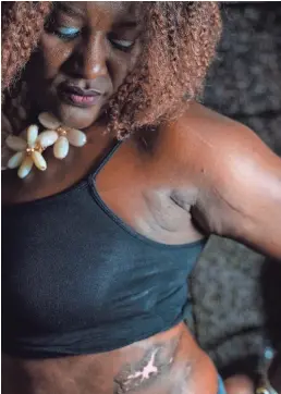  ?? JARRAD HENDERSON/USA TODAY ?? Nicola Mason, 46, says her botched surgery at a Miami clinic left her with unsightly scars. “It’s outrageous,” she says.