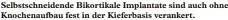  ?? ?? Selbstschn­eidende Bikortikal­e Implantate sind auch ohne Knochenauf­bau fest in der Kieferbasi­s verankert.