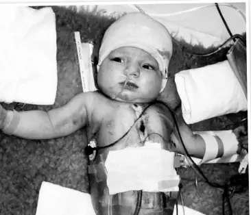  ??  ?? A baby in intensive care following surgery in the 1970s.