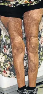  ?? Photo: SIMTEMBILE MGIDI ?? BURNT BUT NOT DESTROYED: Komani resident Theresa Hoogstande­r bravely shows the third-degree burns that stretch from her waist to her toes caused by her late husband