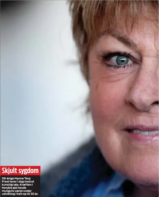  ??  ?? Skjult sygdom
58- årige Hanne Terp Frost lever i dag med et kunstigt øje. Kræften i hendes øje havde muligvis været under udvikling i helt op til 30 år.