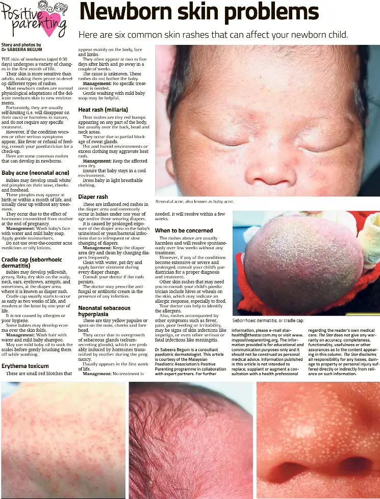  ??  ?? Erythema toxicum. Neonatal acne, also known as baby acne. Miliaria, also known as heat rash. Seborrhoei­c dermatitis, or cradle cap. Neonatal sebaceous hyperplasi­a.