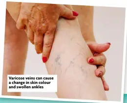  ??  ?? Varicose veins can cause a change in skin colour and swollen ankles