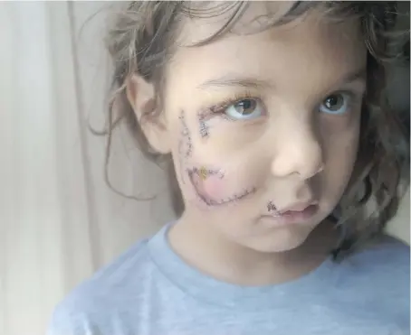  ?? DAX MELMER ?? A total of 75 stitches were required to repair wounds to little Karma Jariett’s face after she was attacked by a dog during a visit to a friend’s house Saturday night. The six-year-old was in surgery for more than two hours the following day, and the...