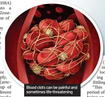  ??  ?? Blood clots can be painful and sometimes life-threatenin­g