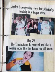  ?? CHERYL CLOCK THE ST. CATHARINES STANDARD ?? Jesse’s mom, Kim Graziano, kept a scrapbook of her daughter’s progress. The bottom photo marks the removal of her tracheotom­y.