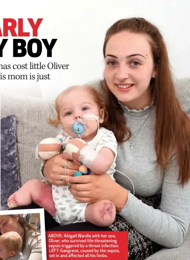  ??  ?? ABOVE: Abigail Wardle with her son, Oliver, who survived life-threatenin­g sepsis triggered by a throat infection. LEFT: Gangrene, caused by the sepsis, set in and affected all his limbs.