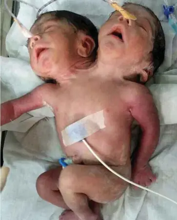  ??  ?? BAYI yang dilahirkan dengan dua kepala di India meninggal dunia 32 jam selepas dilahirkan.