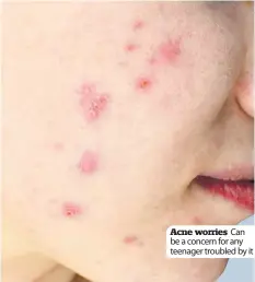  ??  ?? Acne worries Can be a concern for any teenager troubled by it