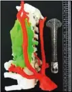  ??  ?? 3D打印鈦合金全頸椎­人工椎體。小文手術後恢復良好。（取材自新聞晨報）